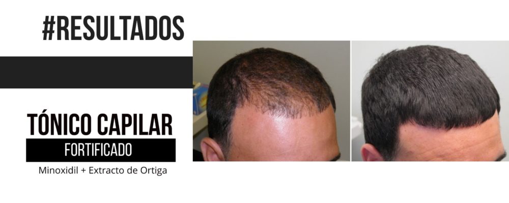 slider-pagina-web-17-1000x400 Barba León - Crecimiento de cabello - información detallada