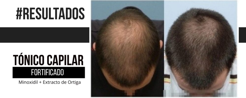 slider-pagina-web-19-1000x400 Barba León - Crecimiento de cabello - información detallada